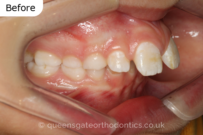 Large overjet due to short lower jaw, causing lower lip trapping and proclination of the upper incisors