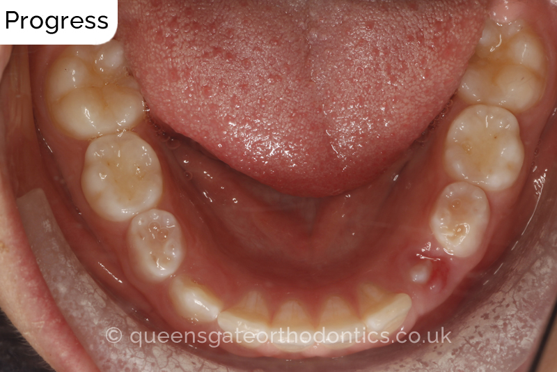 Large overjet due to short lower jaw, causing lower lip trapping and proclination of the upper incisors
