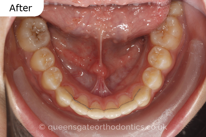 A large anterior open bite due to thumb sucking