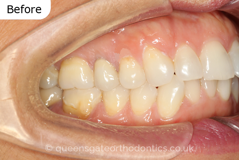 Crowded lower incisors