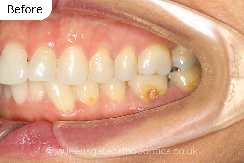 Crowded lower incisors