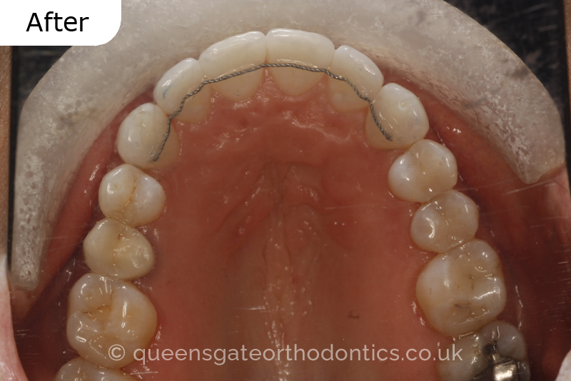 Crowded lower incisors