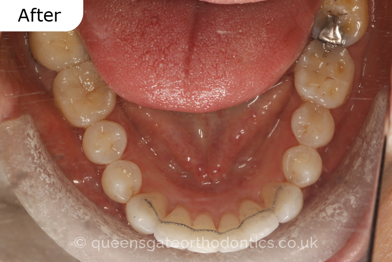 Crowded lower incisors