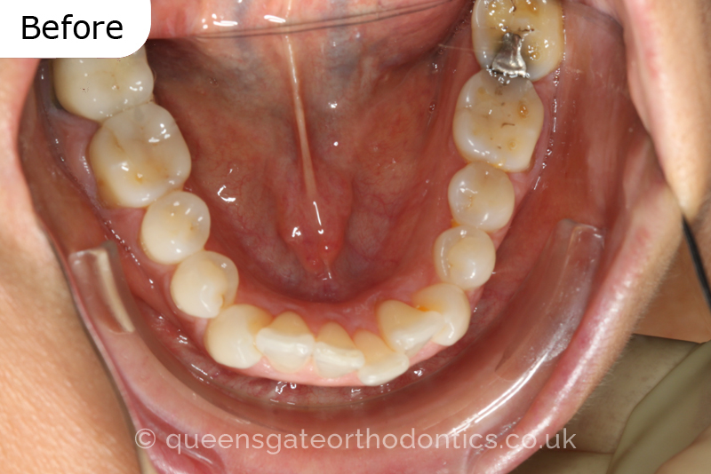 Crowded lower incisors