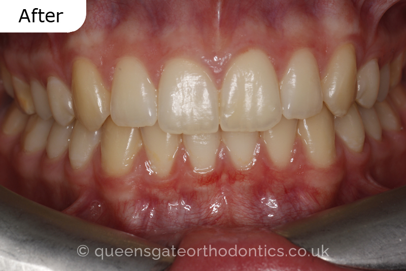 A misaligned class II bite and incisor crowding