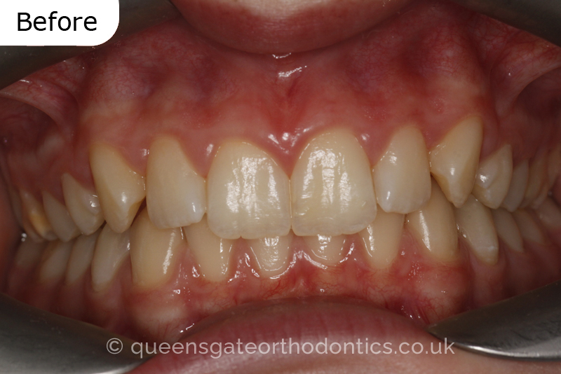 A misaligned class II bite and incisor crowding