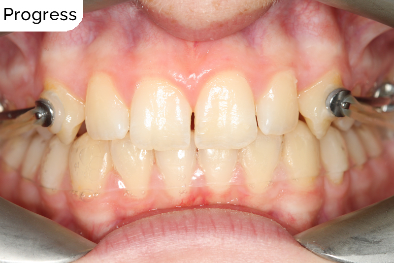A misaligned class II bite and incisor crowding