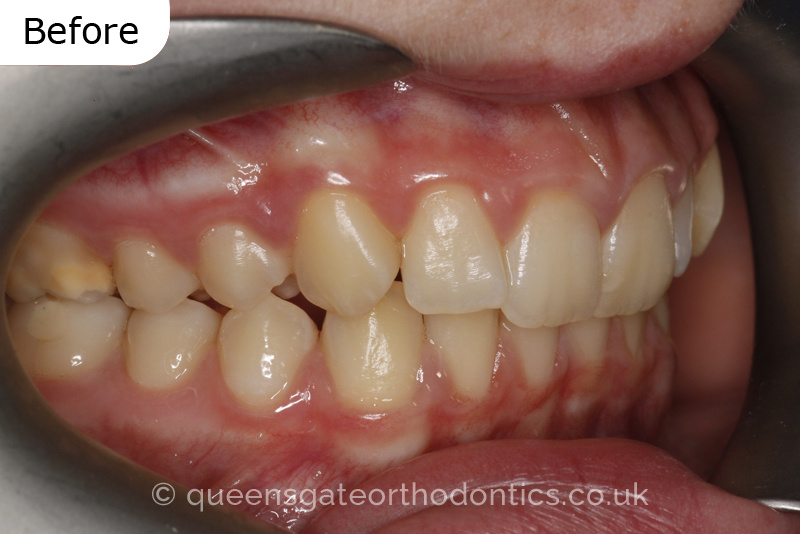 A misaligned class II bite and incisor crowding