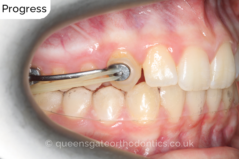 A misaligned class II bite and incisor crowding