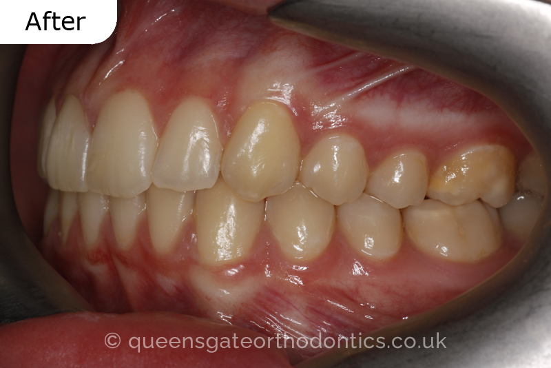 A misaligned class II bite and incisor crowding