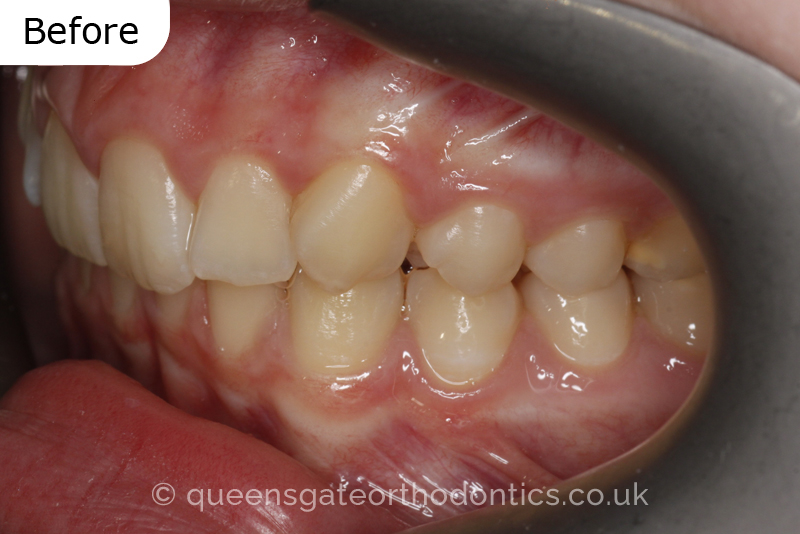 A misaligned class II bite and incisor crowding