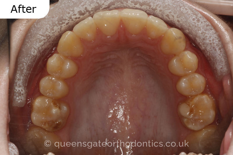 A misaligned class II bite and incisor crowding