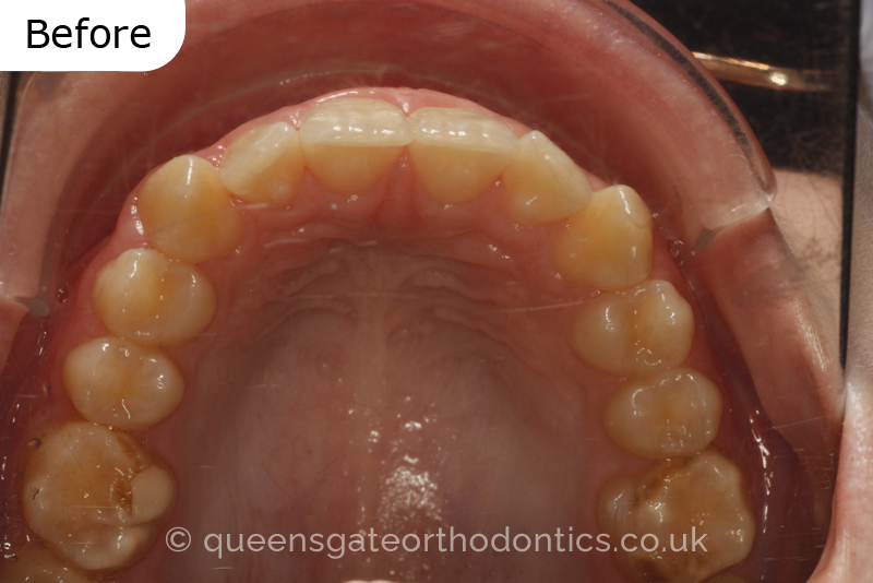 A misaligned class II bite and incisor crowding