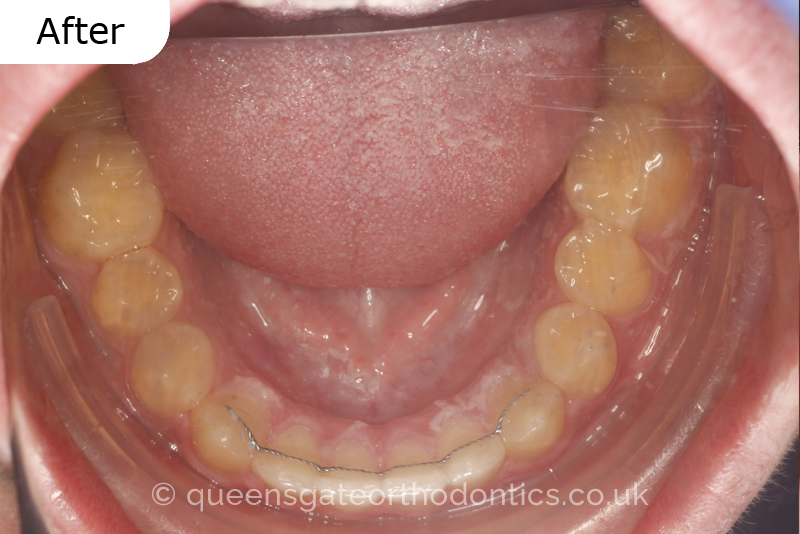 A misaligned class II bite and incisor crowding