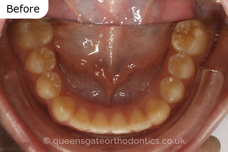 A misaligned class II bite and incisor crowding