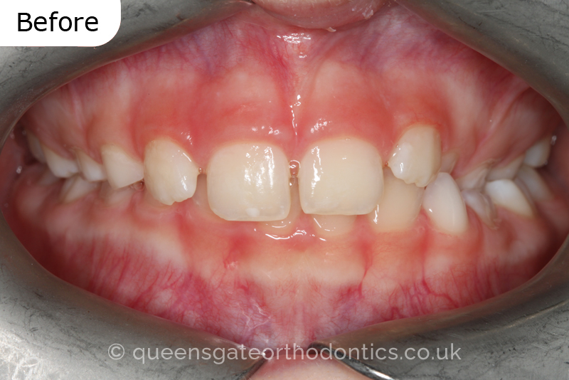 A unilateral crossbite in an 8-year-old child