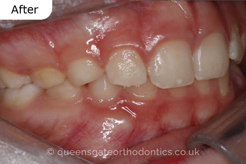 A unilateral crossbite in an 8-year-old child