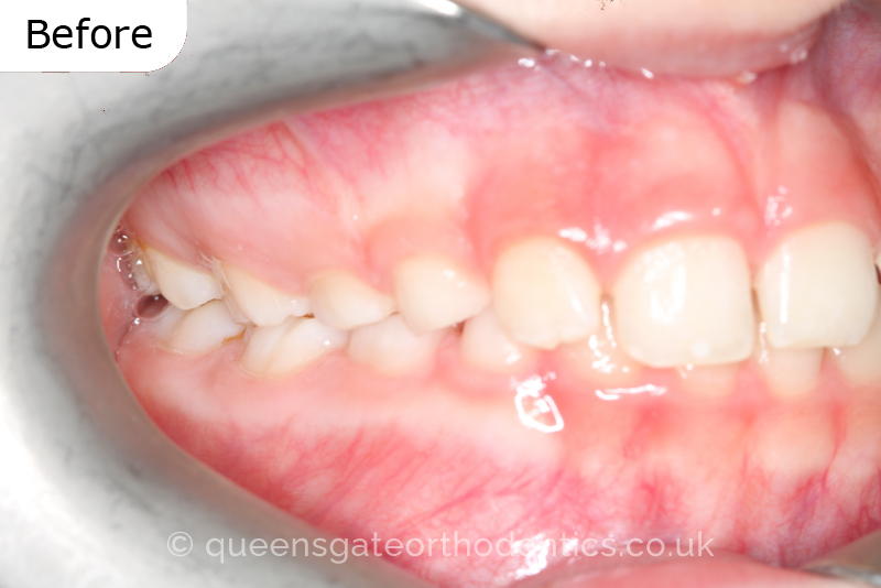 A unilateral crossbite in an 8-year-old child