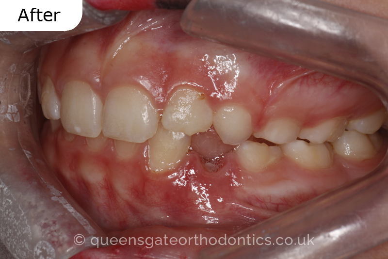 A unilateral crossbite in an 8-year-old child