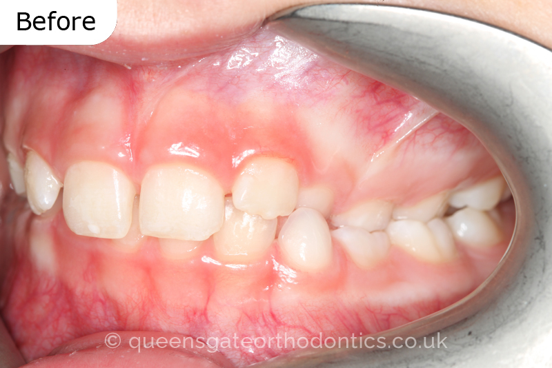 A unilateral crossbite in an 8-year-old child