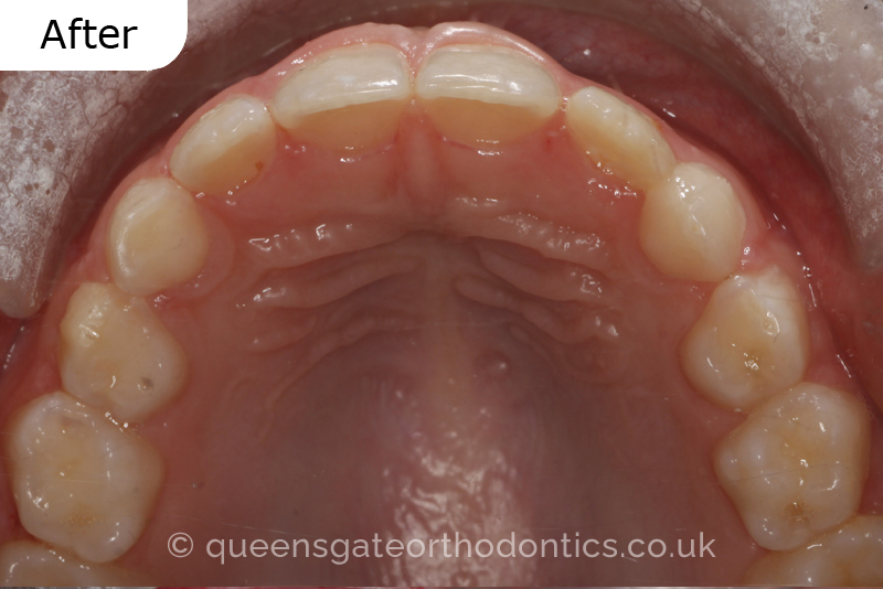 A unilateral crossbite in an 8-year-old child