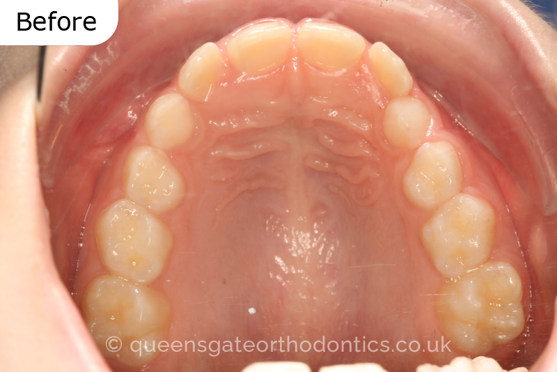 A unilateral crossbite in an 8-year-old child