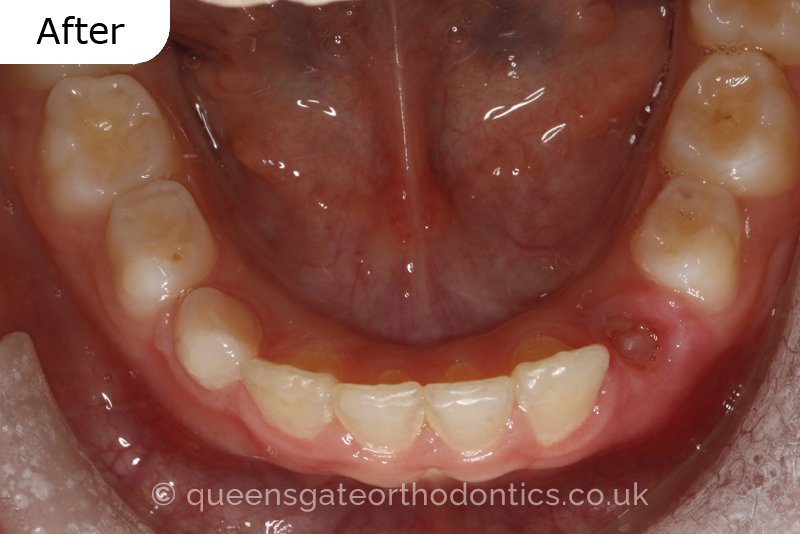 A unilateral crossbite in an 8-year-old child