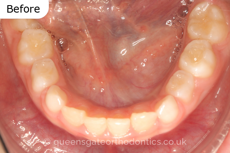 A unilateral crossbite in an 8-year-old child