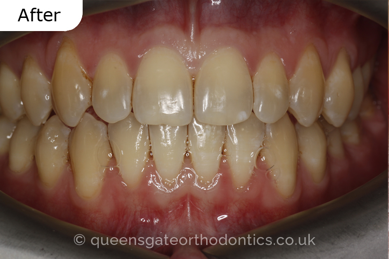 An anterior open bite, unilateral crossbite, and incisor crowding