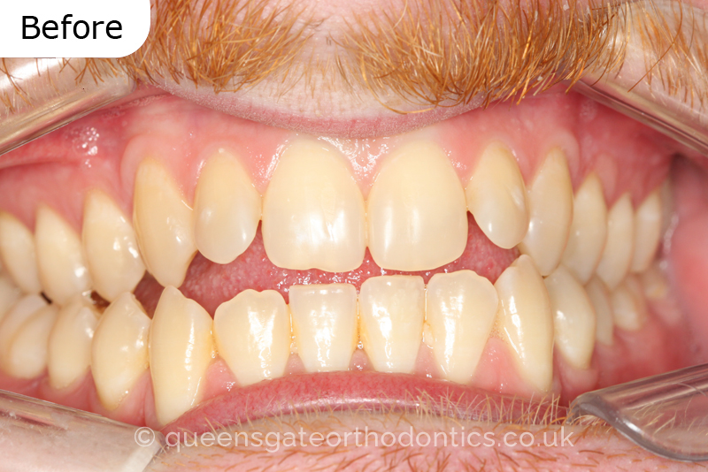 An anterior open bite, unilateral crossbite, and incisor crowding