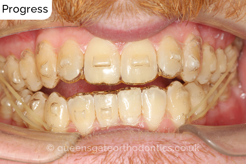 An anterior open bite, unilateral crossbite, and incisor crowding