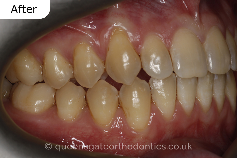 An anterior open bite, unilateral crossbite, and incisor crowding