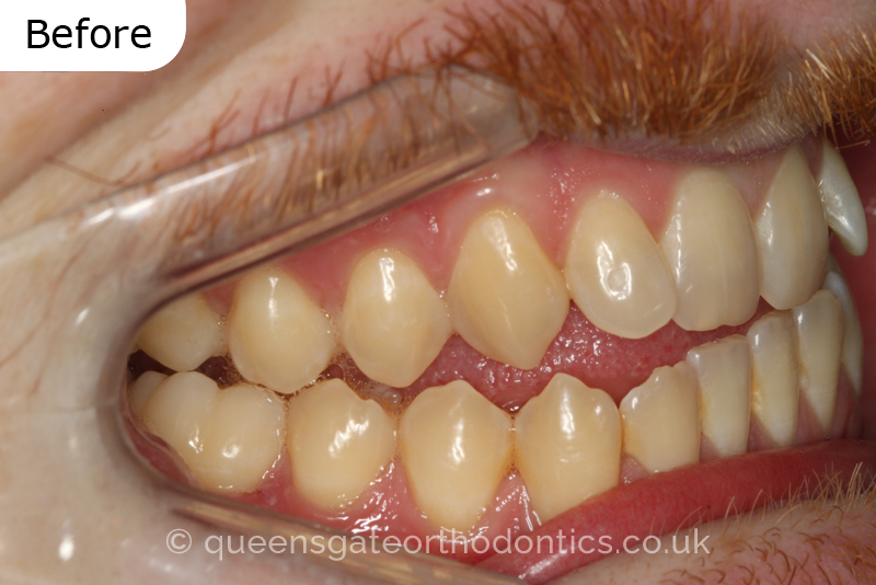 An anterior open bite, unilateral crossbite, and incisor crowding