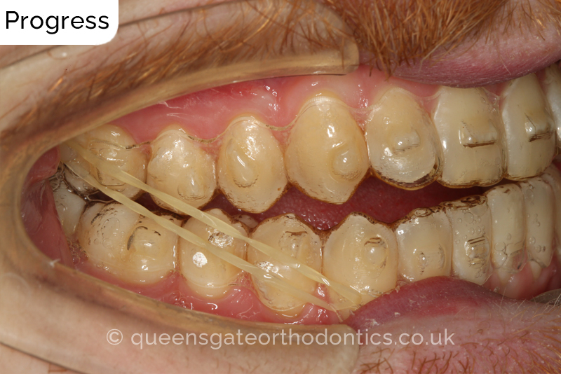 An anterior open bite, unilateral crossbite, and incisor crowding