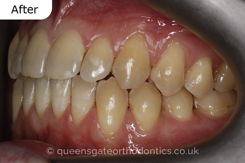 An anterior open bite, unilateral crossbite, and incisor crowding