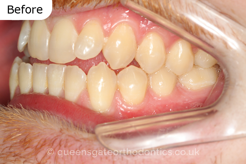 An anterior open bite, unilateral crossbite, and incisor crowding