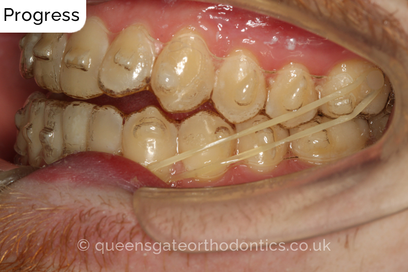 An anterior open bite, unilateral crossbite, and incisor crowding