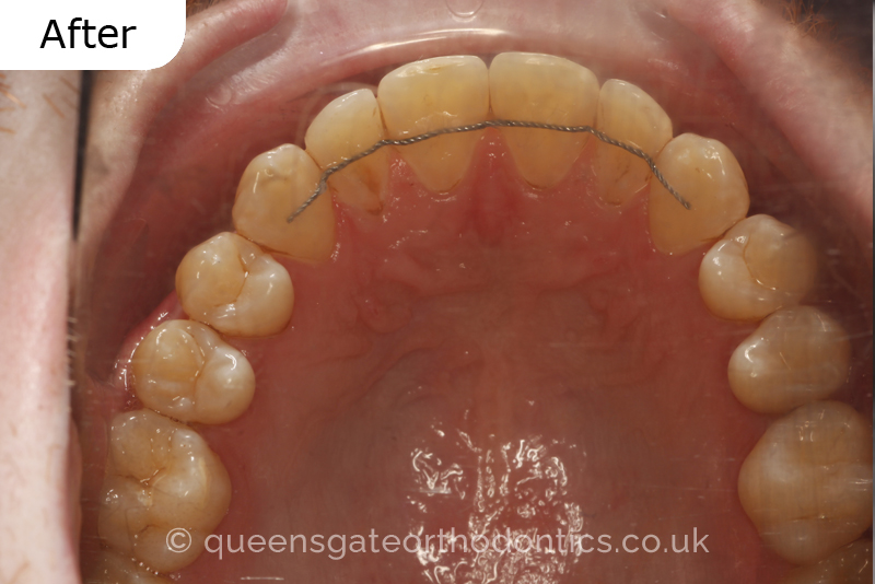 An anterior open bite, unilateral crossbite, and incisor crowding