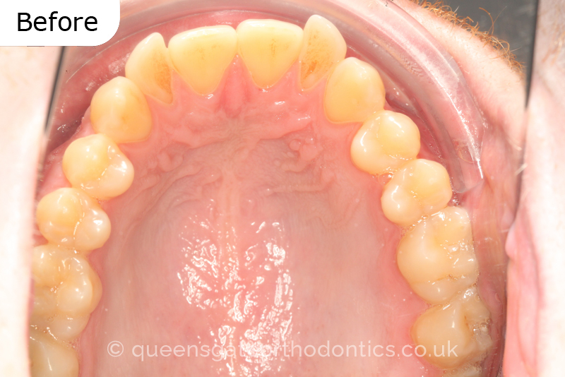 An anterior open bite, unilateral crossbite, and incisor crowding