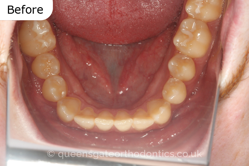 An anterior open bite, unilateral crossbite, and incisor crowding