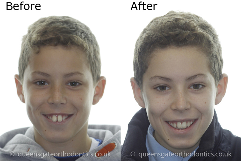 Interceptive orthodontic treatment