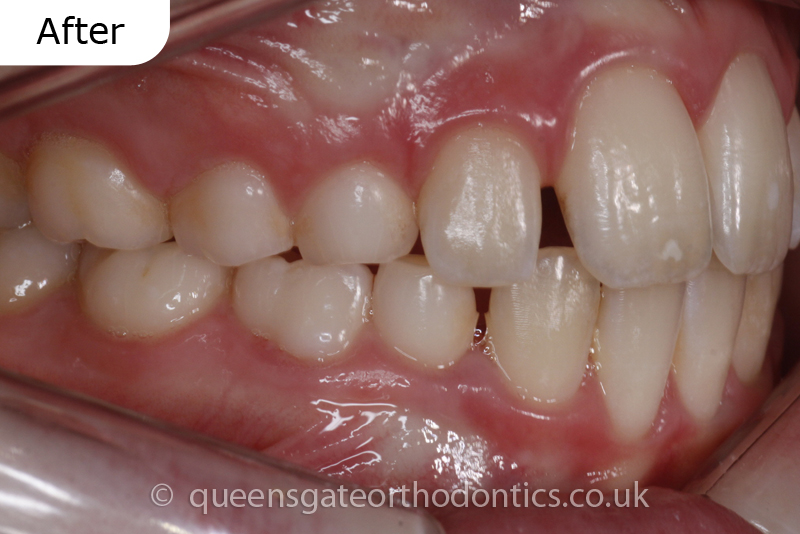 Interceptive orthodontic treatment