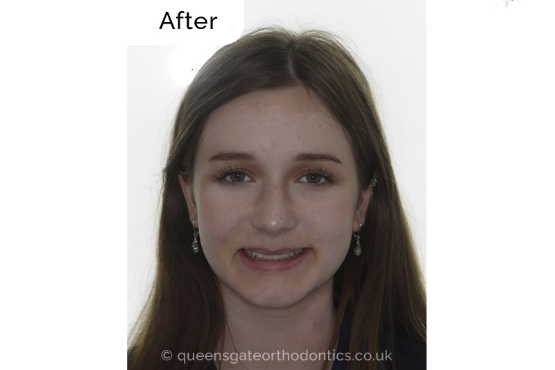 Interceptive orthodontic treatment