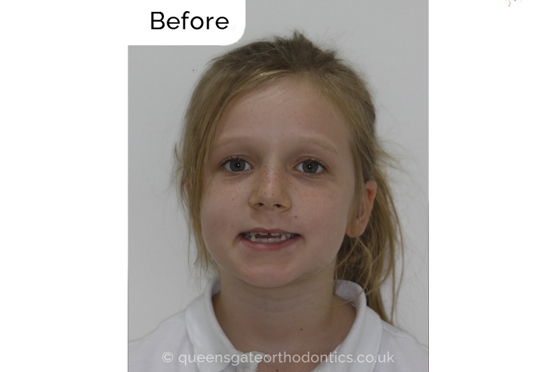 Interceptive orthodontic treatment