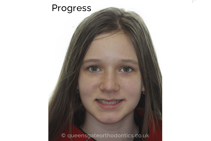 Interceptive orthodontic treatment