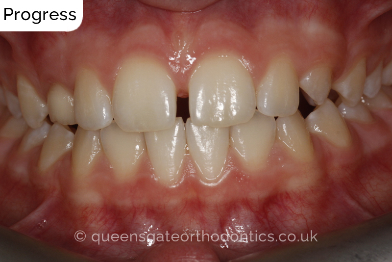 Interceptive orthodontic treatment