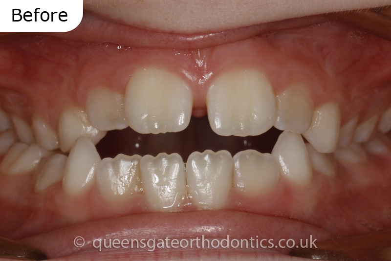 Interceptive orthodontic treatment