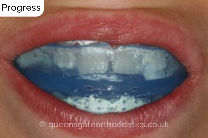 Interceptive orthodontic treatment