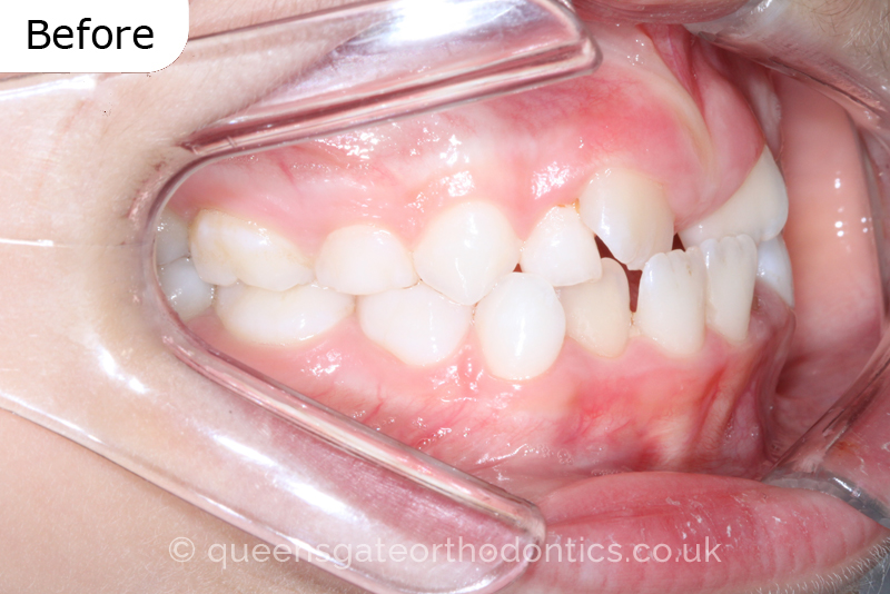 Interceptive treatment