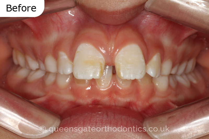 Large overjet due to short lower jaw, causing lower lip trapping and proclination of the upper incisors